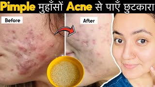 सिर्फ 7 दिनों में PIMPLESमुंहासे दागधब्बे Acne Marks को जड़ से खत्म करेंपाए बेदाग़ Glowing Skin💕 [upl. by Ireland10]