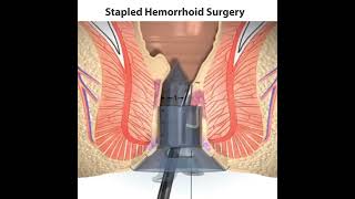 Stapled Hemorrhoids Surgery  Jyoti Nursing Home  Best Piles Hospital In Jaipur [upl. by Vatsug748]