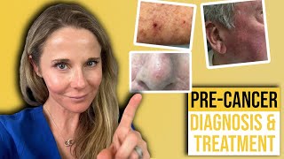 Actinic keratosis treatment guide from a Dermatologist [upl. by Sheply]