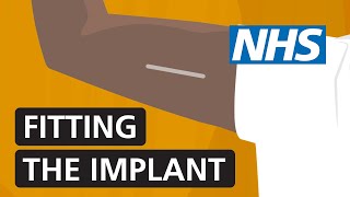 Fitting the contraceptive implant  NHS [upl. by Leasi575]