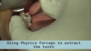 Physics forceps Atraumatic molar tooth extraction [upl. by Nivrac]