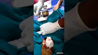 hemodialysis femoral line done youtubeshort emergency hospital [upl. by Alien790]