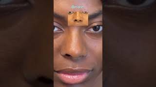 NOSE JOB ALARPLASTY BEFORE amp AFTER  DR TANVEER JANJUA NEW JERSEY [upl. by Norahc]