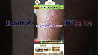 Eczema ayurvedic skin care [upl. by Fiske]