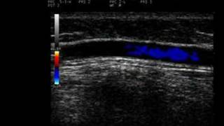 Phlebology Biosound Esaote MyLab 25 Proximal GSV with Reflux [upl. by Notniuqal]