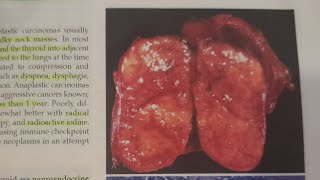 Medullary Thyroid Carcinoma  SPECIAL PATHOLOGY [upl. by Guthrie]