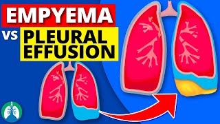 Pleural Effusions  Transudate Exudate amp Lymphatic [upl. by Anilorak276]