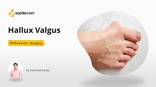 Hallux Valgus  Orthopedic Surgery Video Lectures  Medical Education  VLearning™ [upl. by Issej]