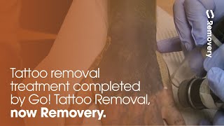 Laser Tattoo Removal On A Blacked Out Hand  Go Tattoo Removal Now Removery [upl. by Ianej47]