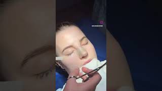 Nose taping rhinoplastysociety drharunacipayam drharunacipayamreviews [upl. by Adnaloj]