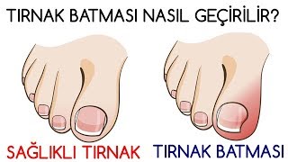 TIRNAK BATMASI NASIL GEÇİRİLİR [upl. by Ifok]