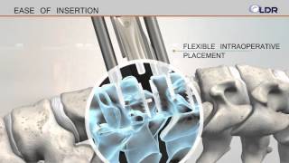 LDR MobiC Cervical Disc Implant Features [upl. by Zarger]