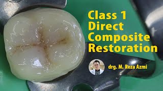 Class I Direct Composite Restoration  Operative Dentistry Polofil NHT Nano Hybrid Composite [upl. by Matheson]