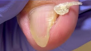 The sharp and long ingrown nails are deeply involuted [upl. by Demeter947]