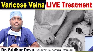 LIVE 🔴 Laser Treatment For Varicose Veins in Legs  Varicose Vein Treatment Procedure  Dr Devu [upl. by Lig]