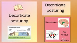 DECORTICATE POSTURE Abnormal posturing [upl. by Eilsil886]