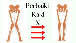 Cara Menyembuhkan Kaki X Lutut Masuk ke Dalam [upl. by Acirrej]