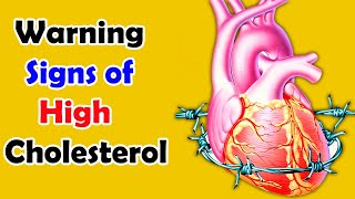 What Are the Warning Signs of High Cholesterol  Side Effect of High Cholesterol [upl. by Rambert]