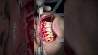 Removing of Large periapical cyst and granuloma  ازاله كيس دهني بالفك dentist doctorsaleemplastic [upl. by Alletse363]