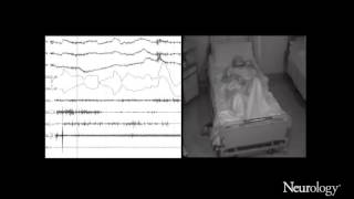 Immunotherapy of oneiric stupor in Morvan syndrome Efficacy documented by actigraphy [upl. by Gavrah]