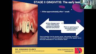 BDS 406PERIODONTOLOGY GINGIVITIS  STAGES OF GINGIVAL INFLAMMATION DR HIMANGI DUBEY [upl. by Okiruy114]