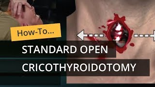 Standard Open Cricothyroidotomy [upl. by Eniaral]