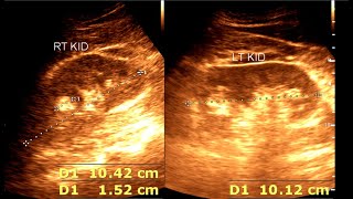 Angiomyolipoma  Renal Mass  Renal Tumor [upl. by Sirroned]