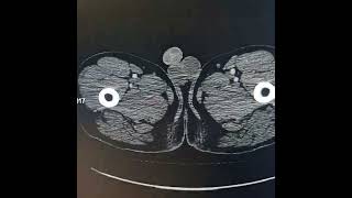 Hepatocellular carcinoma Horse shoe kidneys [upl. by Ardeha700]