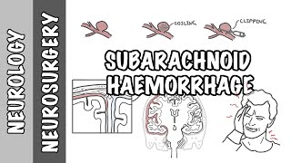 Subarachnoid Haemorrhage  pathophysiology complications and management [upl. by Houston]