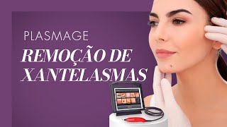 PLASMAGE  Remoção de Nevus [upl. by Viola10]