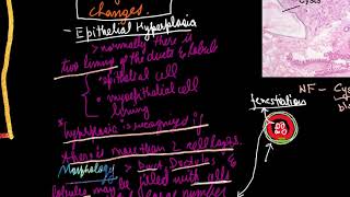 Fibrocystic Changes of the Breast in Hindi language [upl. by Connor10]