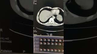 How to do Triphasic CT scan  planning and parameters [upl. by Belinda]