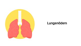 Lungenödem  Erkrankungen der Atemwege [upl. by Ronnie]