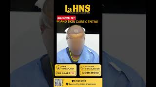 quotRegain Your Confidence Regrow Your Hairquot  Lahns  Hair transplant  Coimbatore [upl. by Leinoto]