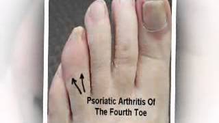 Arthritis of the Feet  Gouty Arthritis  Stiffness of feet [upl. by Ahsenit]