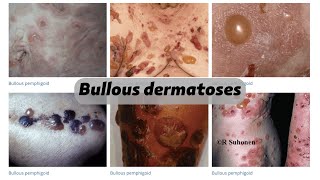 Bullous dermatoses [upl. by Marsh683]