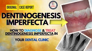 DENTINOGENESIS IMPERFECTA AN ORIGINAL CASE REPORT dentist youtubegrowth youtubegrow dentistry [upl. by Noivad114]