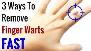 How to Get Rid of Warts on Fingers Fast  3 Natural Wart Remedies [upl. by Jeramie]