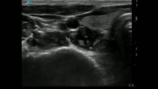 Ultrasound Guided Stellate Ganglion Block [upl. by Assiluj]