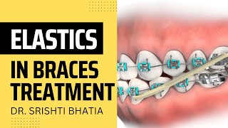 ELASTICS in Braces Treatment Dr Srishti Bhatia [upl. by Esikram]