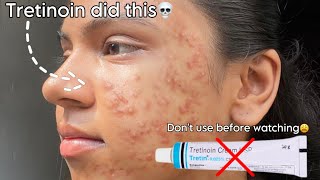 Tretinoin mistakes that ruined my skin 😫 tretinoin skincare beauty [upl. by Corron137]