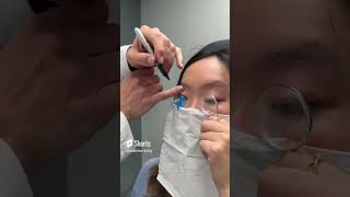 Fitting A Scleral Lens With Eyeprint Pro keratoconus eyedoctor dryeyes contactlenses [upl. by Bertila292]