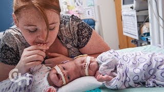 Conjoined Twins Abby and Erin Delaney A Year in the Life [upl. by Einnaej436]