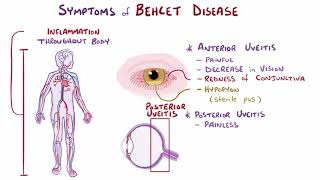 Behcet disease causes symptoms diagnosis treatment pathology [upl. by Elimac463]