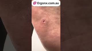 Painful corn and callus removal in podiatry clinic by Australian podiatrist with live naration and [upl. by Pascasia]