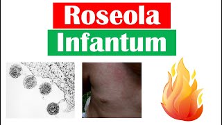 Roseola Infantum Sixth Disease  Symptoms Fever amp Rash in Infants Diagnosis Treatment [upl. by Carisa]