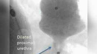 BOTOX for detrusor sphincter dyssynergia [upl. by Gotthelf]