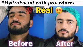 HydraFacial Treatment Before amp After  PART1  Complete guide to HydraFacial  O Beauty Dose [upl. by Naruq]