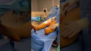 Lipedema Liposuction  Behind the Scene  Dr Boris Volshteyn [upl. by Chew]