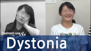 Cervical Dystonia Dystonia Spasmodic Torticollis  사경증 치료사례  근긴장이상증 [upl. by Madlen890]